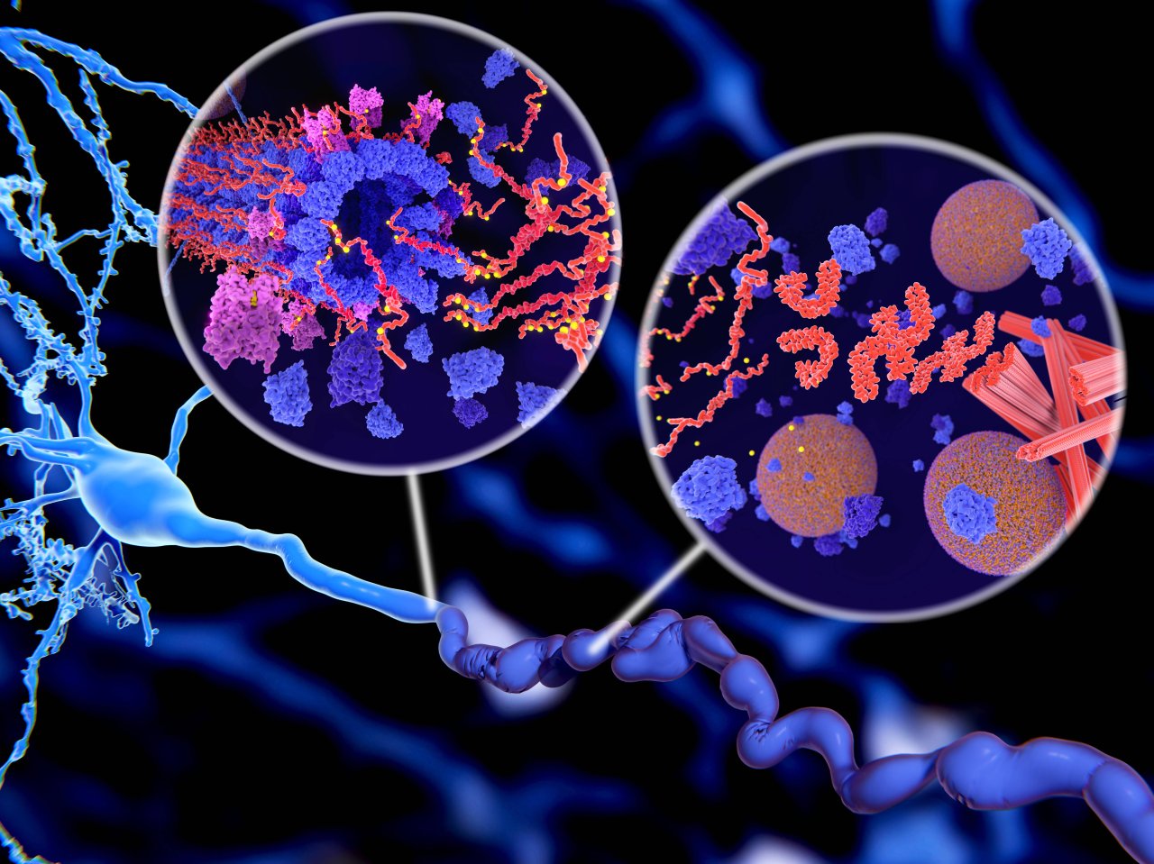 Tau-Protein bei einer Alzheimer-Erkrankung.